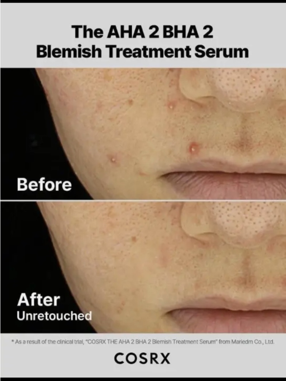 Cosrx The AHA 2 BHA 2 Blemish Treatment Serum - Picture 7 of 10